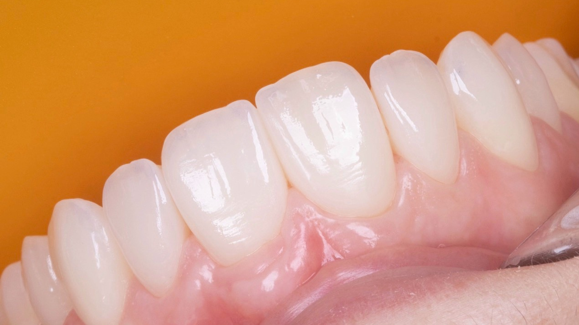 Reabilitação Oral Estética Biomimética com Planeamento Clínico Avançado_2