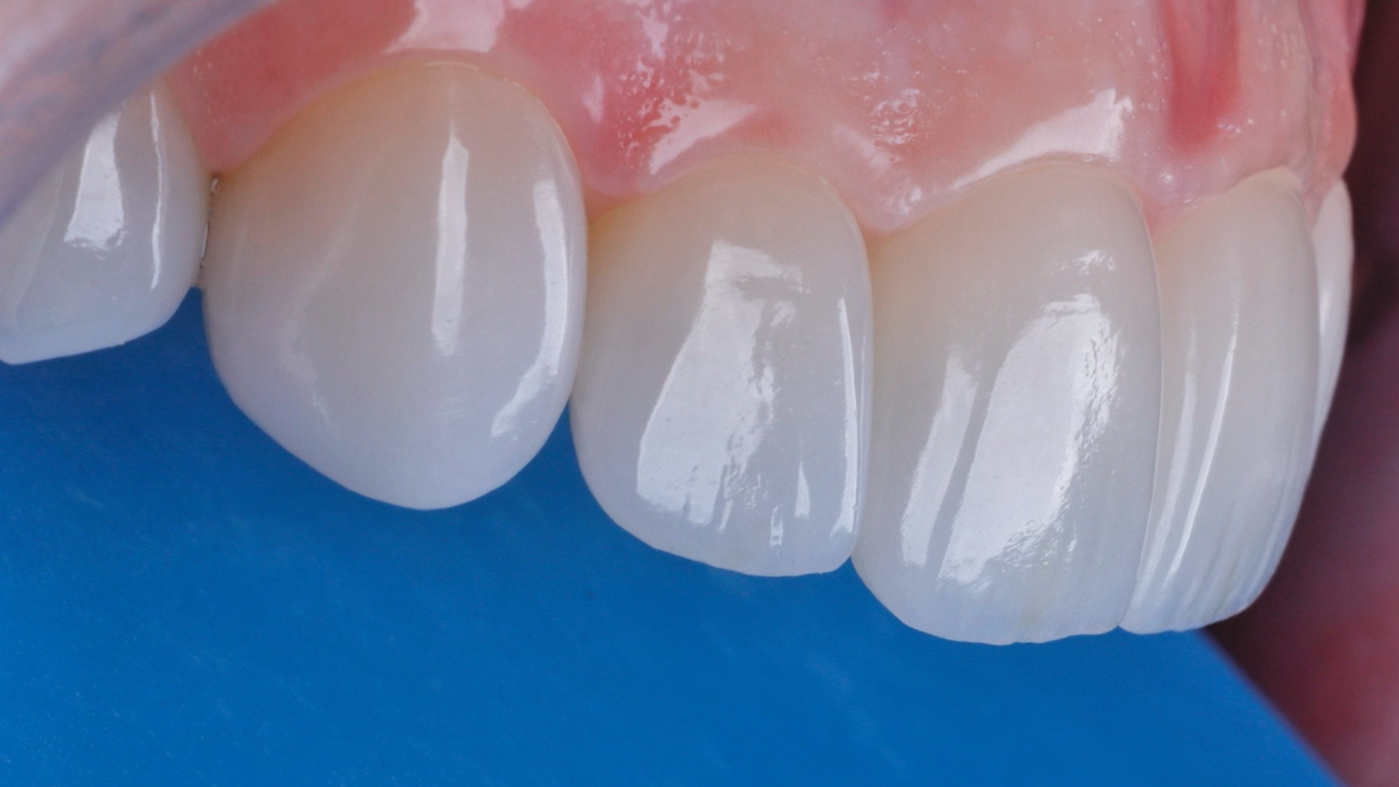 Reabilitação Oral Estética Biomimética com Planeamento Clínico Avançado_3