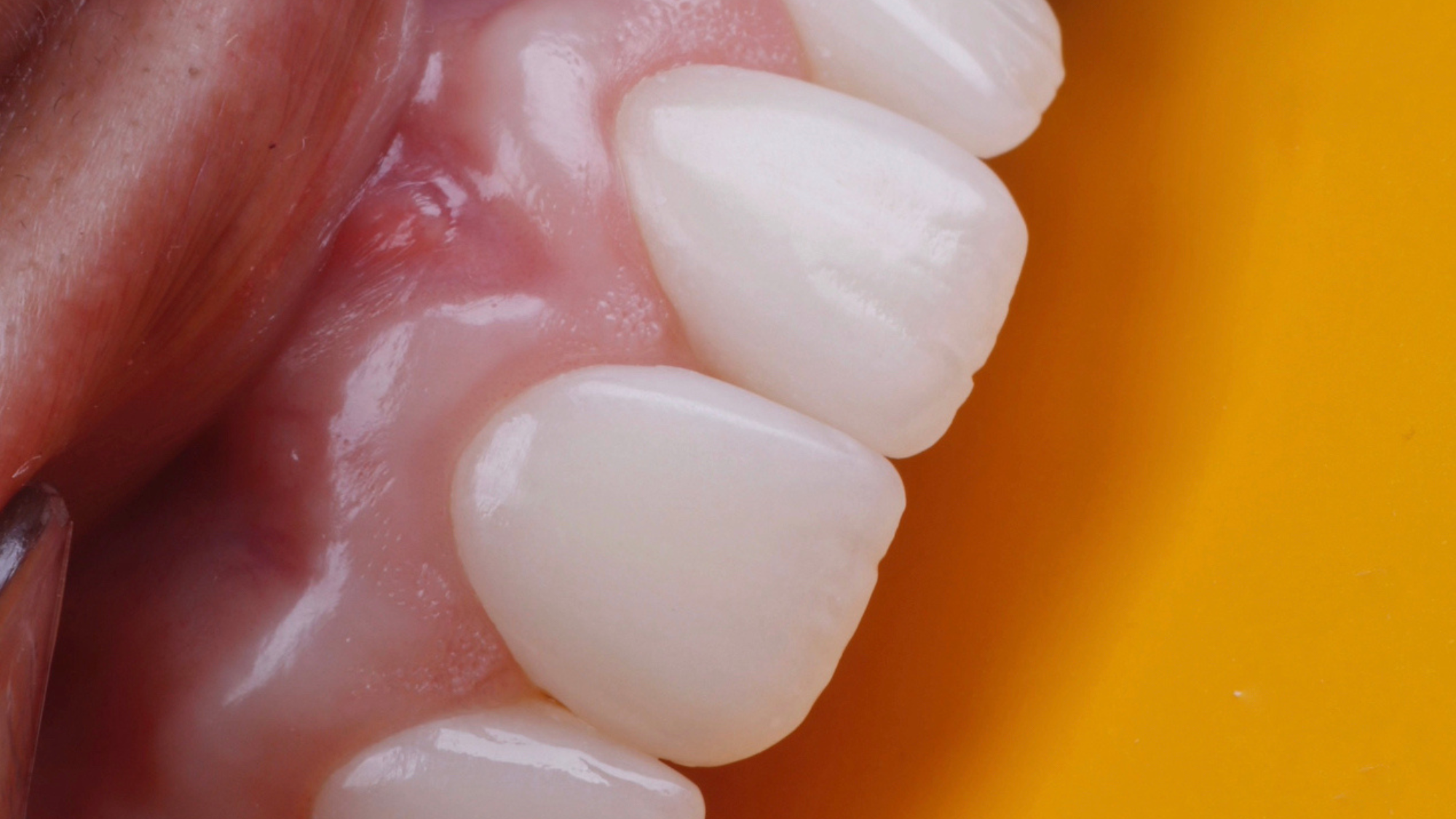 Reabilitação Oral Estética Biomimética com Planeamento Clínico Avançado_9